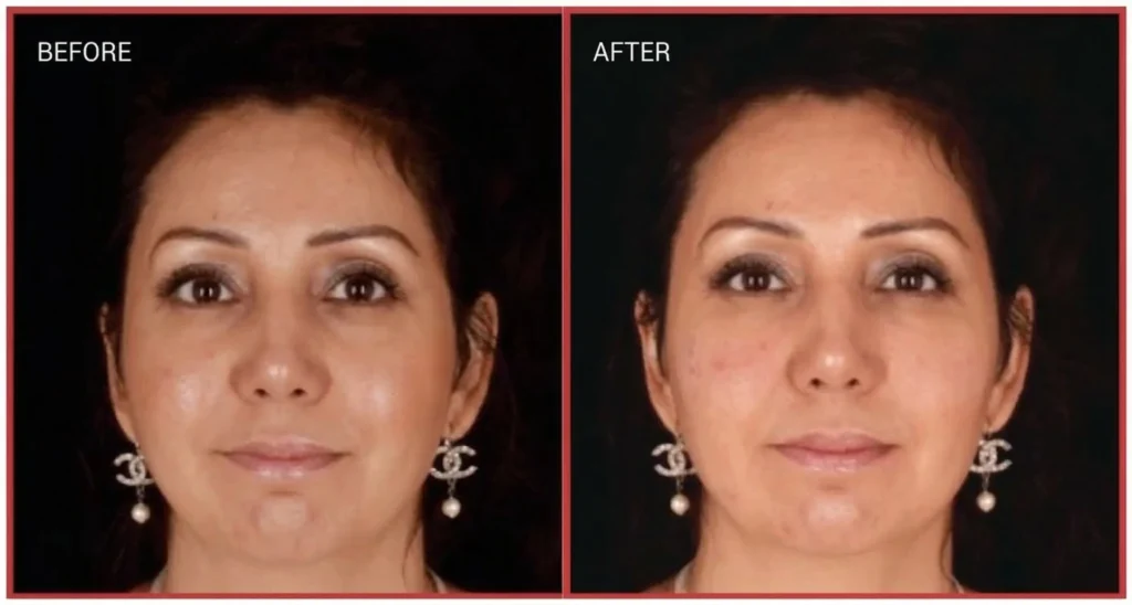 A clinical comparison of under-eye rejuvenation after PRF EZ Gel treatment, demonstrating natural collagen production and volume restoration
